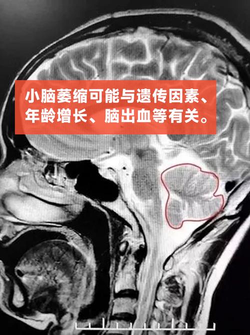送小脑萎缩儿子高考,小脑萎缩能上学吗